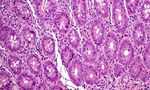 PROGRESSI DELLA RICERCA SULLA CELIACHIA: NON SOLO NUOVE TERAPIE - AIC ...