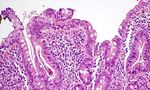 PROGRESSI DELLA RICERCA SULLA CELIACHIA: NON SOLO NUOVE TERAPIE - AIC ...