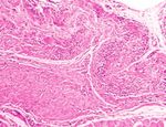 Tutomesh e Fortiva 1 mm - Matrici tissutali per Ricostruzione Mammaria - WOUND CARE - Biomedica Italia Srl