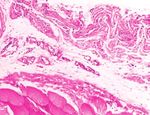 Tutomesh e Fortiva 1 mm - Matrici tissutali per Ricostruzione Mammaria - WOUND CARE - Biomedica Italia Srl
