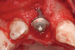 Rigenerazione perimplantare - Geistlich