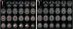 Neurobiologia dell'ADHD: modelli interpretativi e strategie operative Adriana Di Martino