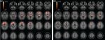 Neurobiologia dell'ADHD: modelli interpretativi e strategie operative Adriana Di Martino