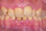 Applicazione del protocollo di Full Mouth Disinfection Modificata nel trattamento di una gengivite localizzata - PROFILASSI