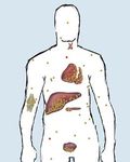 Vivere con le trasfusioni - Suggerimenti per pazienti e famiglie - Leben mit Transfusionen