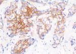 Sicurezza diagnostica. Efficienza del laboratorio - Leica Bond Oracle HER2 IHC System per carcinoma della mammella - Leica Biosystems