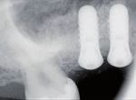 Sinergia per il successo! - ß-Fosfato tricalcico Idrossiapatite