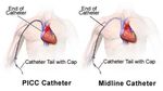 CATETERI VENOSI CVC-PICC-MIDLINE - Guida di rapida consultazione Indicazione - Classificazione Caratteristiche - Gestione
