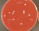CERANEWS FOCUS: IMPINGEMENT DELLO PSOAS INFEZIONE ARTICOLARE PERIPROTESICA - CERANEWS - CERAMTEC