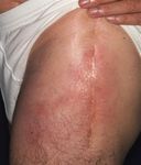 CERANEWS FOCUS: IMPINGEMENT DELLO PSOAS INFEZIONE ARTICOLARE PERIPROTESICA - CERANEWS - CERAMTEC