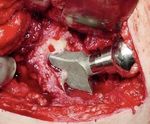 CERANEWS FOCUS: IMPINGEMENT DELLO PSOAS INFEZIONE ARTICOLARE PERIPROTESICA - CERANEWS - CERAMTEC