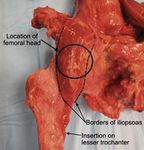 CERANEWS FOCUS: IMPINGEMENT DELLO PSOAS INFEZIONE ARTICOLARE PERIPROTESICA - CERANEWS - CERAMTEC