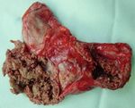 CERANEWS FOCUS: IMPINGEMENT DELLO PSOAS INFEZIONE ARTICOLARE PERIPROTESICA - CERANEWS - CERAMTEC