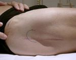 CERANEWS FOCUS: IMPINGEMENT DELLO PSOAS INFEZIONE ARTICOLARE PERIPROTESICA - CERANEWS - CERAMTEC
