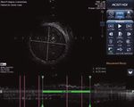 Sistema ACIST | HDi HD IVUS - Il sistema ideale per l'ottimizzazione dell'imaging - ACIST Medical Systems