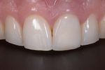 Corso teorico-pratico di protesi fissa su denti naturali e impianti secondo tecnica B.O.P.T. Per clinici e odontotecnici