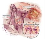 Gestione del paziente con Clostridium difficile in PS - F. Franceschi Fondazione Policlinico Universitario A. Gemelli, Universit&agrave; Cattolica, Roma ...
