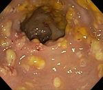 Gestione del paziente con Clostridium difficile in PS - F. Franceschi Fondazione Policlinico Universitario A. Gemelli, Universit&agrave; Cattolica, Roma ...