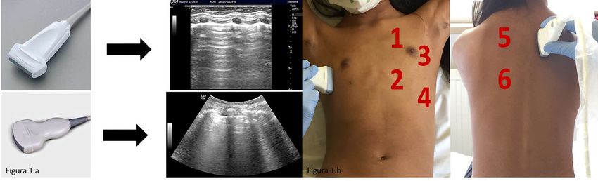 L'Ecografia Polmonare: Quale Ruolo In Pneumologia Pediatrica?