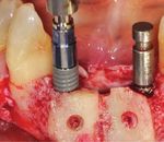 CORSO OPERATIVO DI CHIRURGIA IMPLANTARE PER CASI BASICI, AVANZATI E COMPLESSI