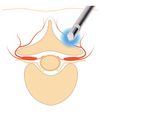 C3 CryoSystem Trattamento del dolore cronico - INTERVENTIONAL PERCUTANEOUS PAIN MANAGEMENT - Biomedica Italia Srl