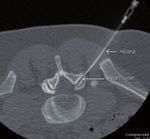 C3 CryoSystem Trattamento del dolore cronico - INTERVENTIONAL PERCUTANEOUS PAIN MANAGEMENT - Biomedica Italia Srl