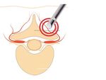 C3 CryoSystem Trattamento del dolore cronico - INTERVENTIONAL PERCUTANEOUS PAIN MANAGEMENT - Biomedica Italia Srl