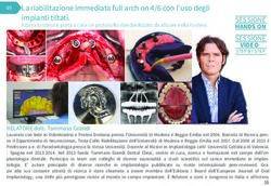 La riabilitazione immediata full arch on 4/6 con l'uso degli impianti tiltati.