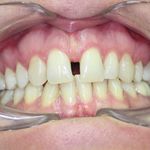 IL POTE- RE DEL TUO SORRISO - Gli allineatori invisibili per correggere le malposizioni dentarie - Biotech Dental