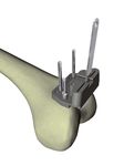 GENUS EMAS Tecnica Chirurgica - EXTRA-MEDULLARY ALIGNMENT SYSTEM Lo strumento micro-invasivo per la protesica di Ginocchio - Adlerortho