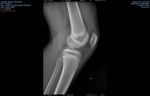 Caso Clinico di Febbraio 2018: Instabilità postero-laterale isolata di ginocchio in paziente pediatrico. Case report e revisione della ...