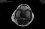 Caso Clinico di Febbraio 2018: Instabilità postero-laterale isolata di ginocchio in paziente pediatrico. Case report e revisione della ...