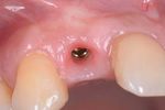 Corso teorico-pratico di protesi fissa su denti naturali e impianti secondo tecnica B.O.P.T. Per clinici e odontotecnici
