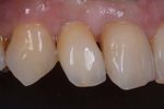 Corso teorico-pratico di protesi fissa su denti naturali e impianti secondo tecnica B.O.P.T. Per clinici e odontotecnici
