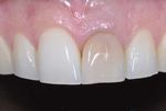Corso teorico-pratico di protesi fissa su denti naturali e impianti secondo tecnica B.O.P.T. Per clinici e odontotecnici
